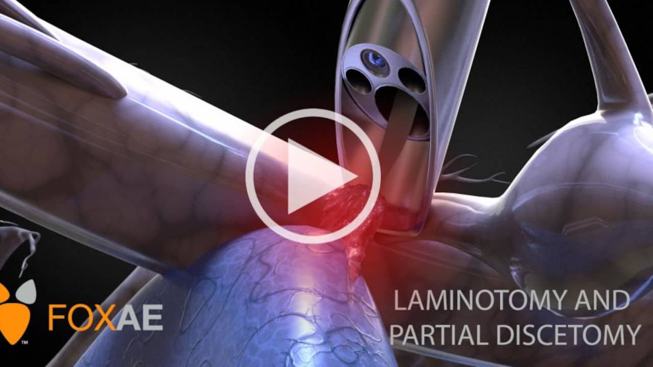 Laminectomy